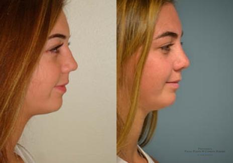 Rhinoplasty: Patient 33 - Before and After 4