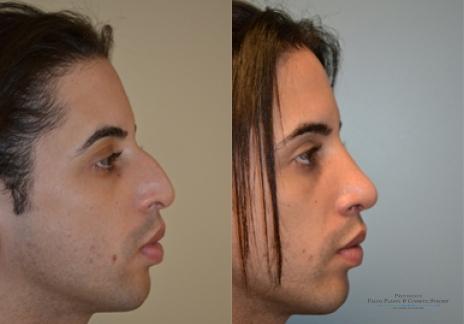 Rhinoplasty: Patient 19 - Before and After 1
