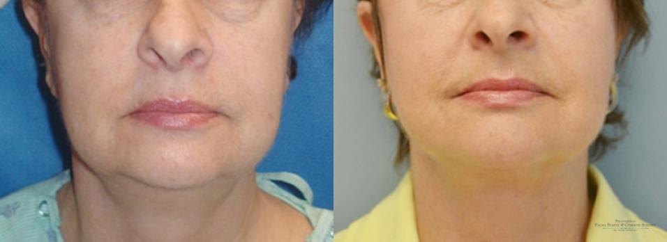 Facelift: Patient 4 - Before and After  
