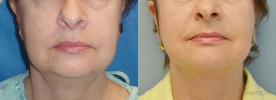 Facelift: Patient 3 - Before and After  