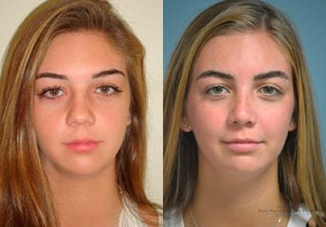 Rhinoplasty: Patient 33 - Before and After 1
