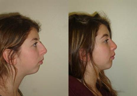 Rhinoplasty: Patient 31 - Before and After 2