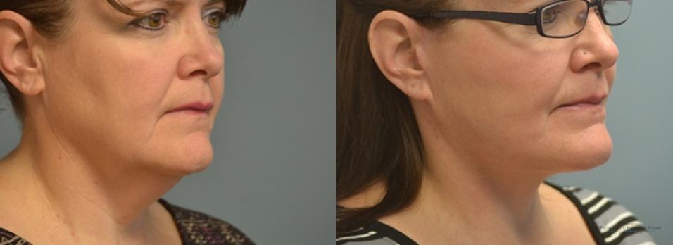 Facelift: Patient 8 - Before and After 4