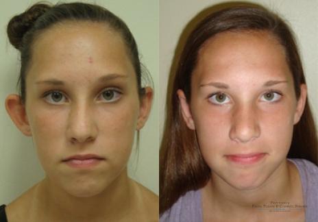 Otoplasty: Patient 1 - Before and After  