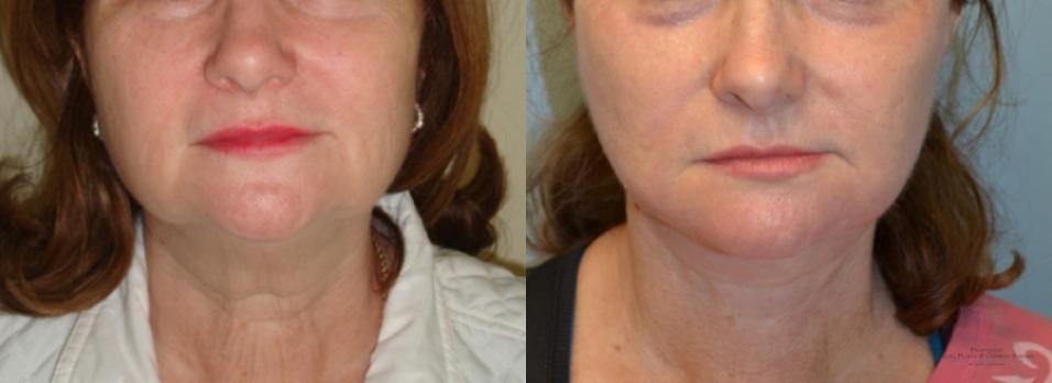 Facelift: Patient 2 - Before and After  