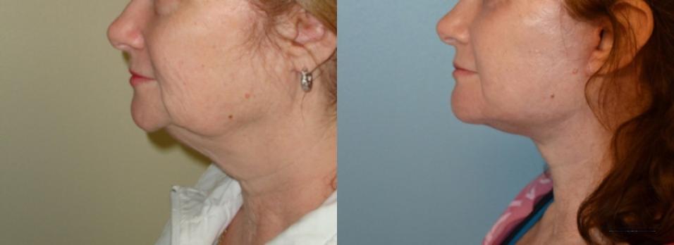 Facelift: Patient 3 - Before and After 3