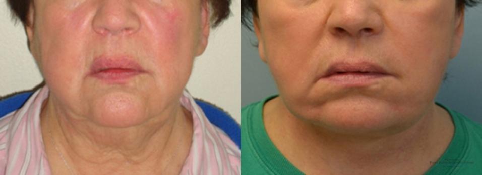 Facelift: Patient 4 - Before and After 2