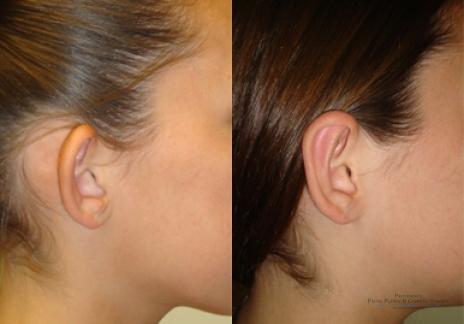 Otoplasty: Patient 1 - Before and After 2