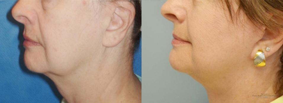 Facelift: Patient 3 - Before and After 3