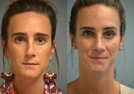 Rhinoplasty: Patient 30 - Before and After 2