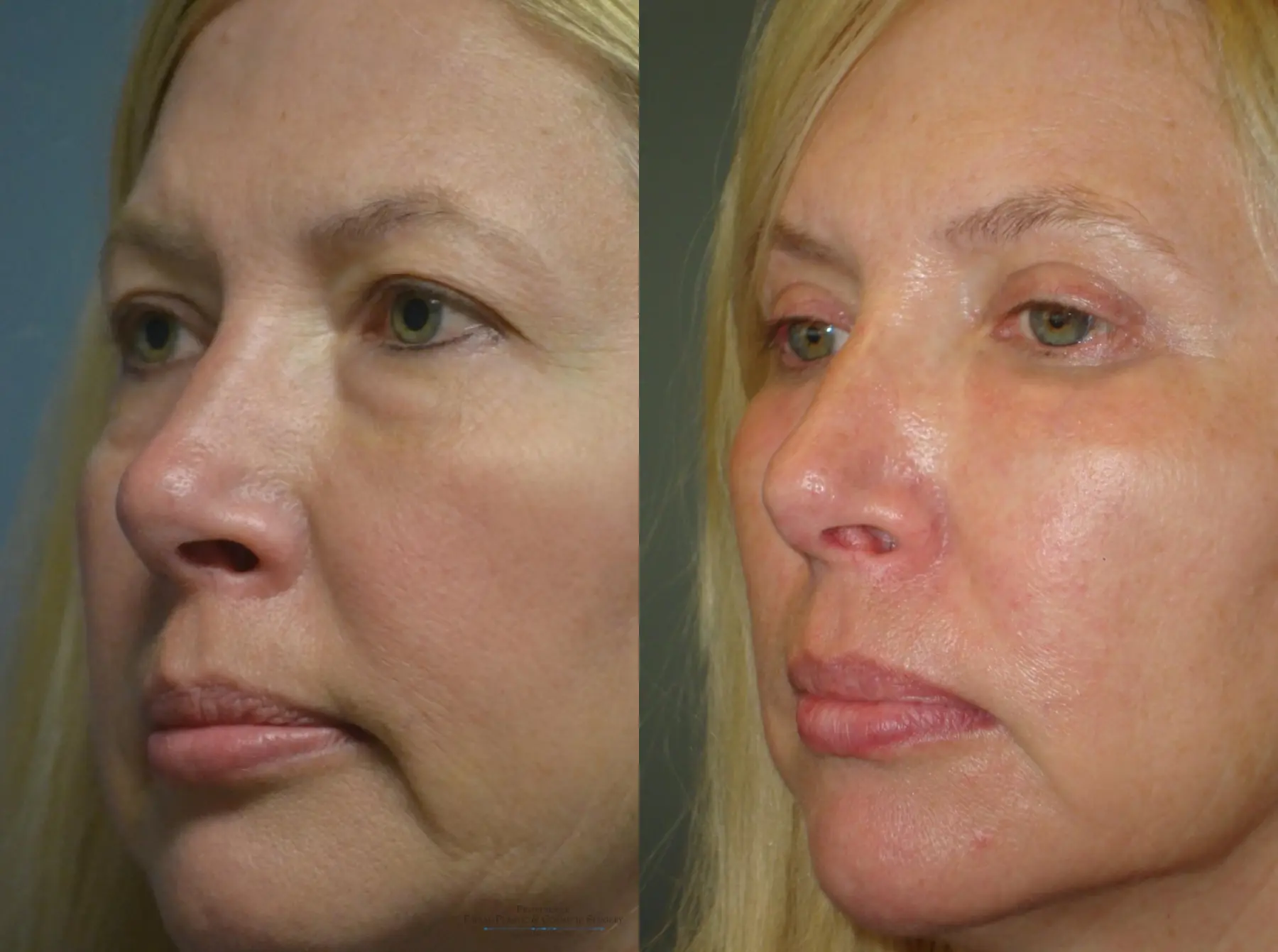 Blepharoplasty: Patient 1 - Before and After 3