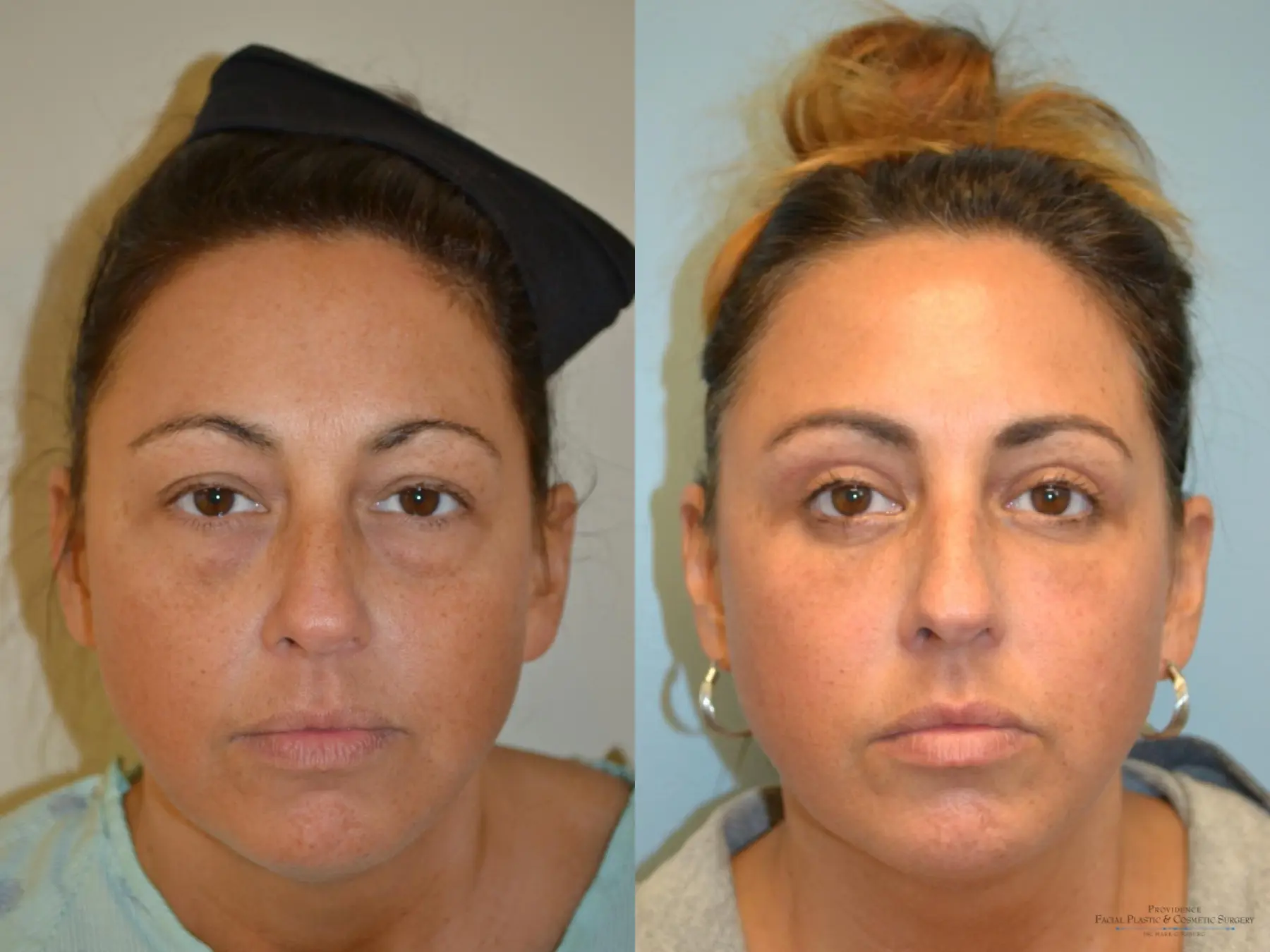 Blepharoplasty: Patient 7 - Before and After  