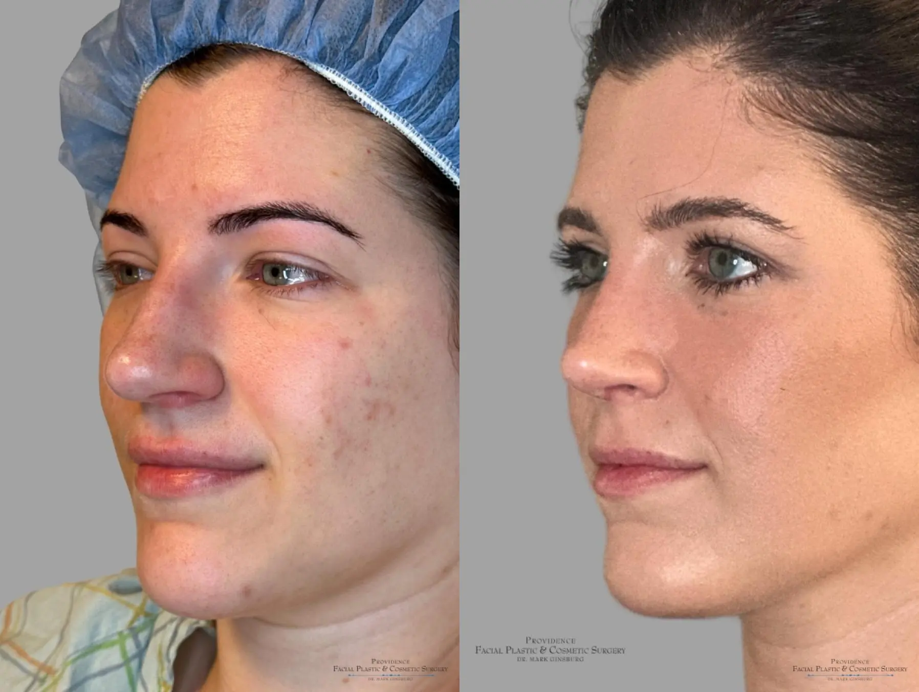 Blepharoplasty: Patient 8 - Before and After 4