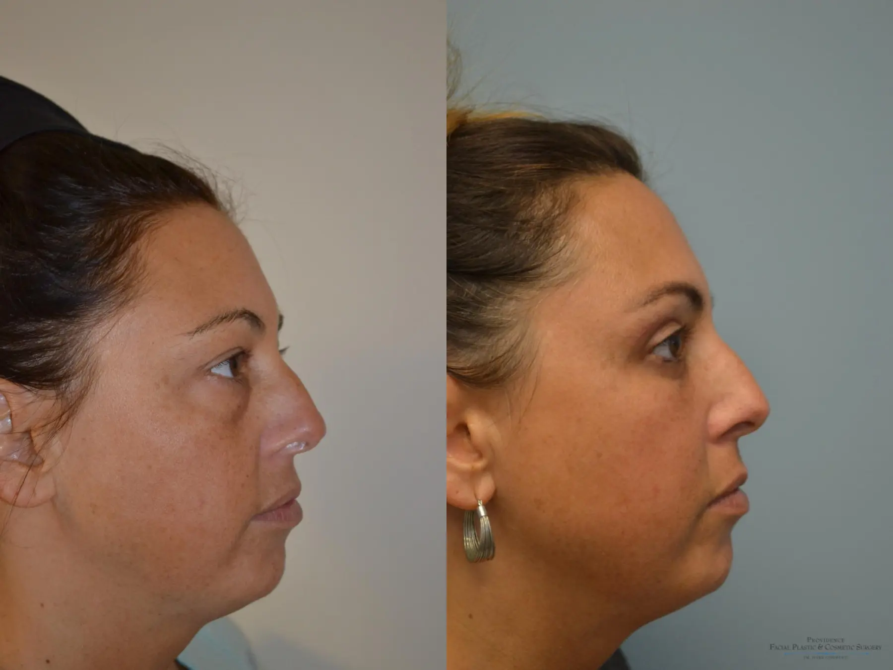 Blepharoplasty: Patient 7 - Before and After 3