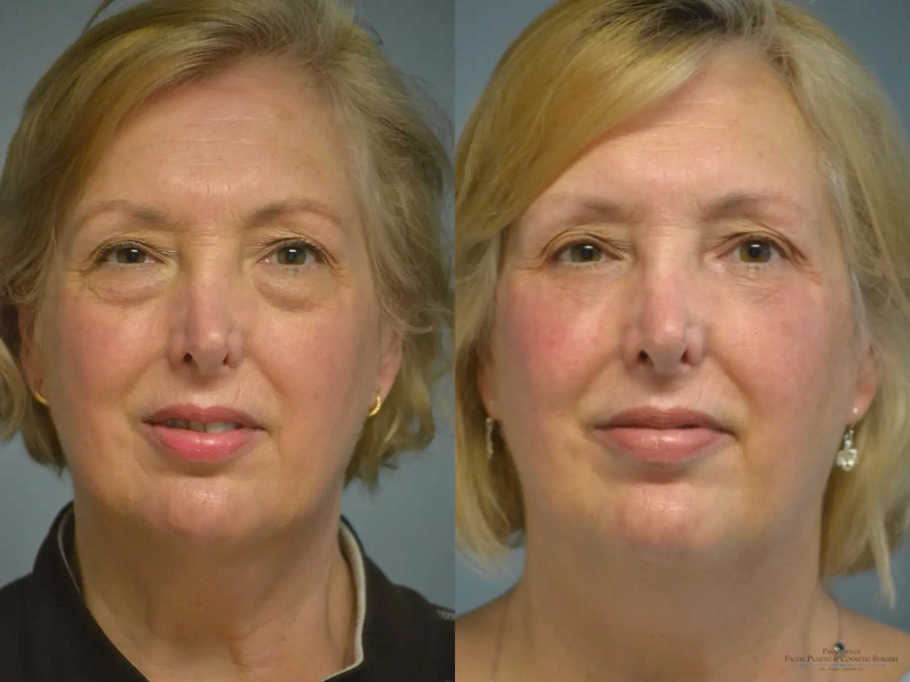 Blepharoplasty: Patient 6 - Before and After  