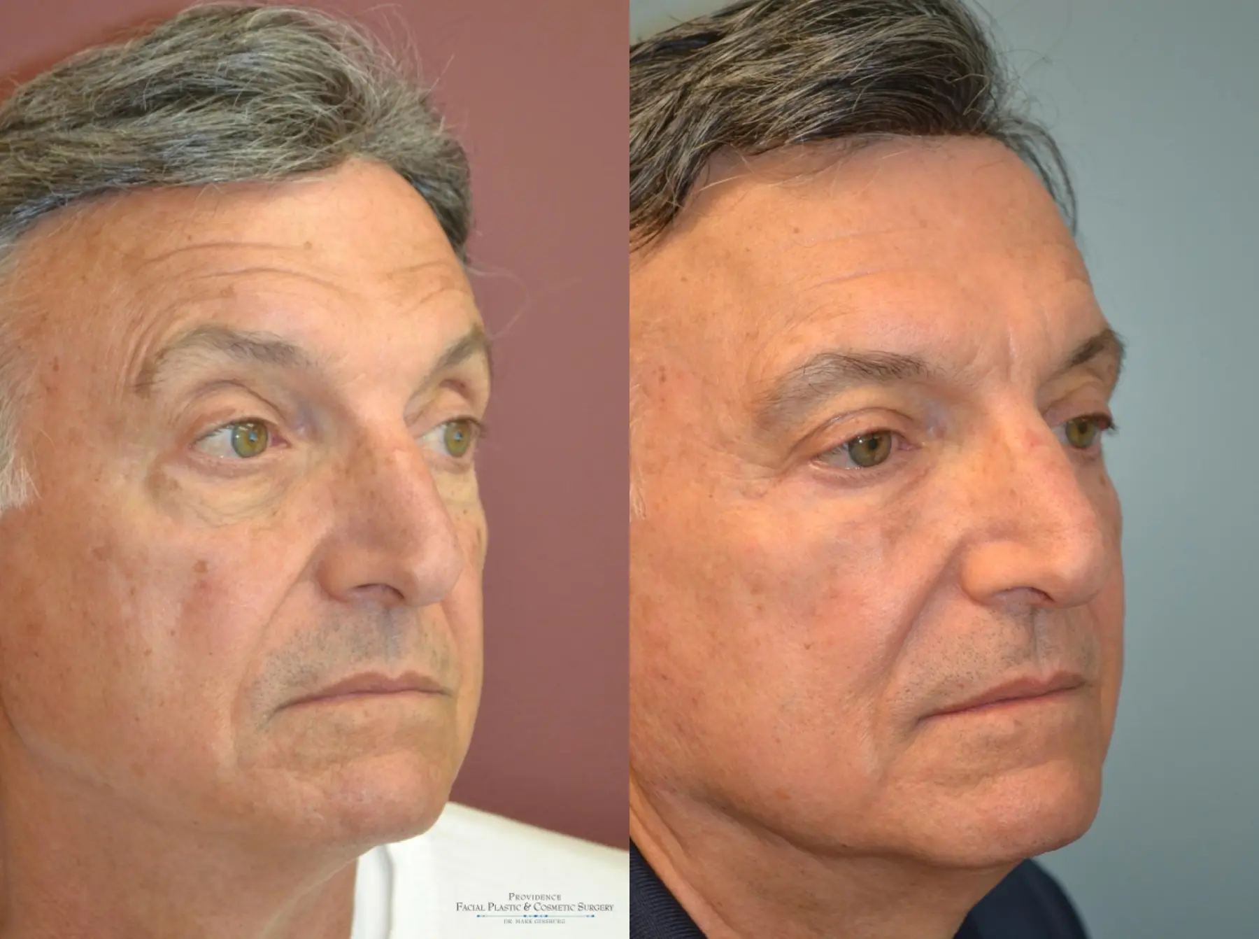 Blepharoplasty: Patient 2 - Before and After 2