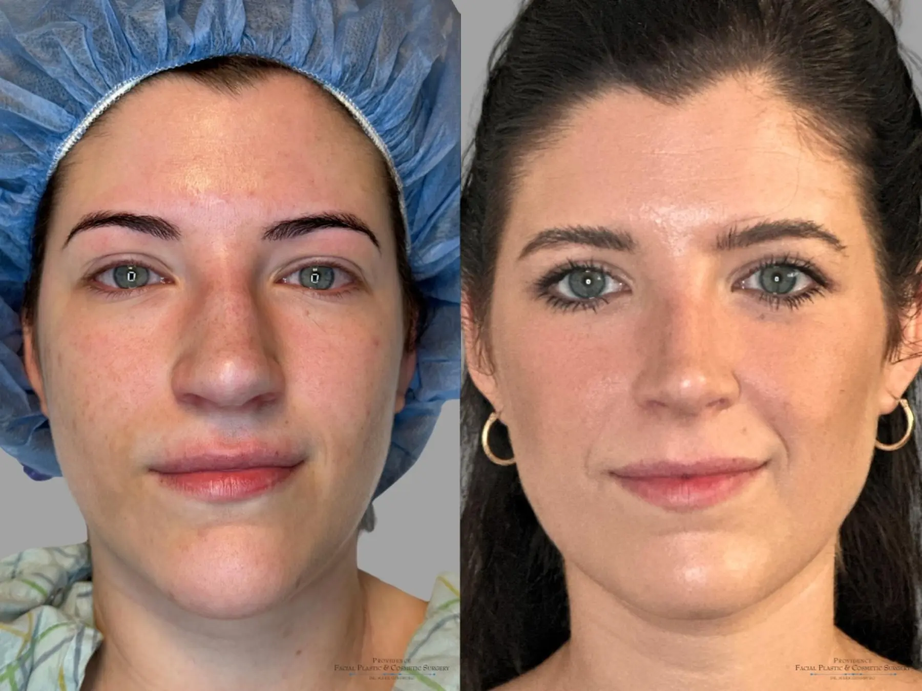 Blepharoplasty: Patient 8 - Before and After 1