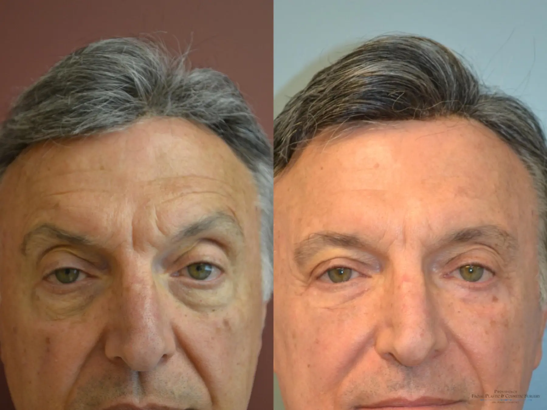 Blepharoplasty: Patient 2 - Before and After 1