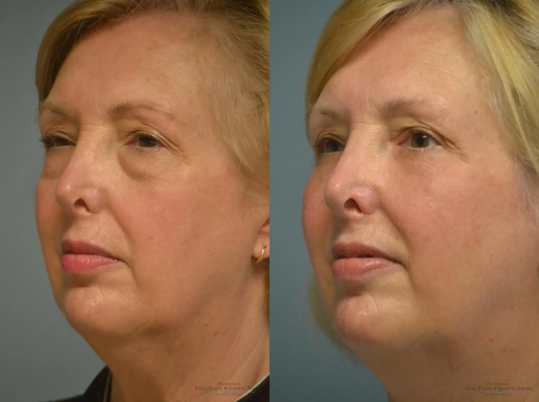 Blepharoplasty: Patient 4 - Before and After 2