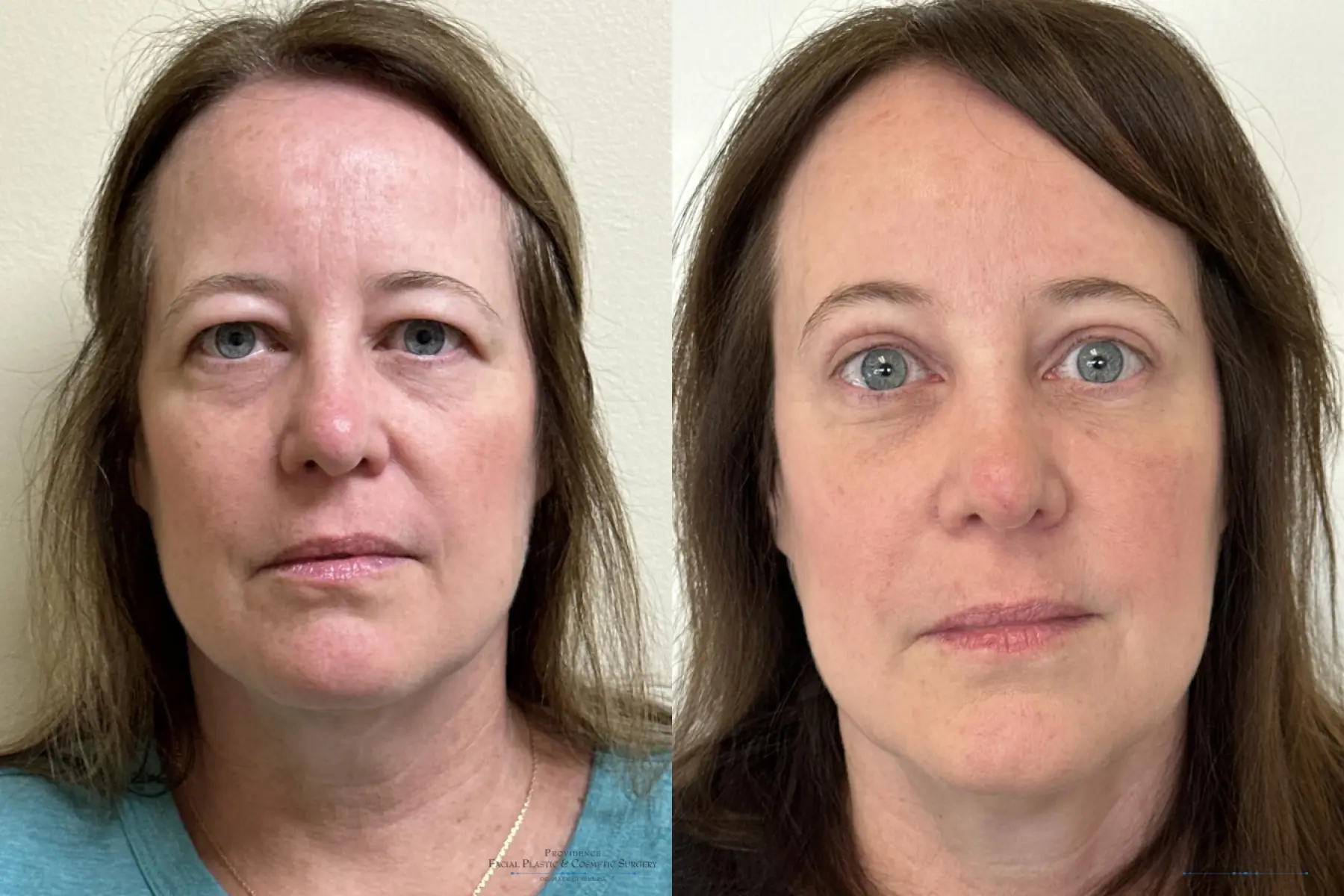 Blepharoplasty: Patient 2 - Before and After  