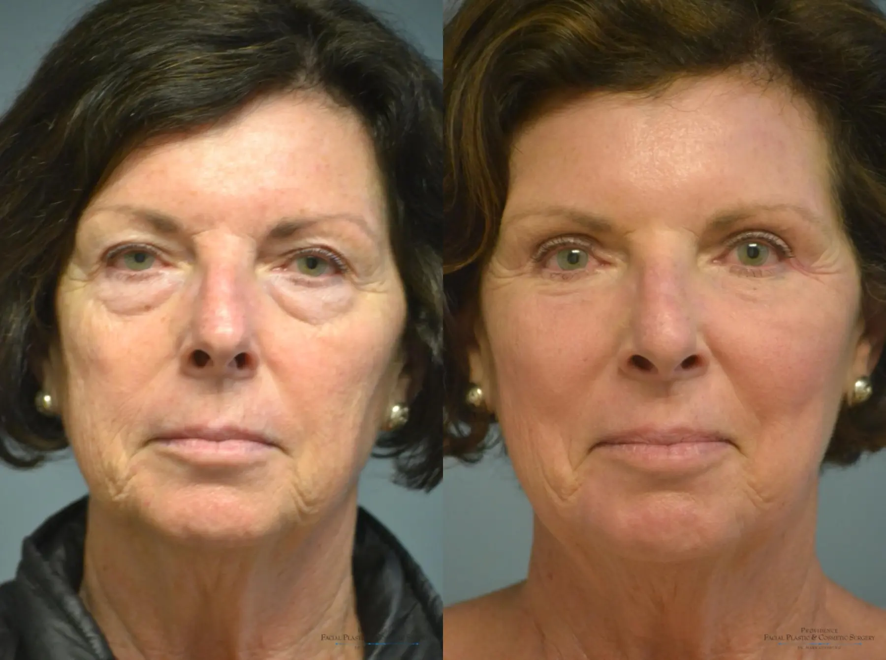Blepharoplasty: Patient 3 - Before and After  