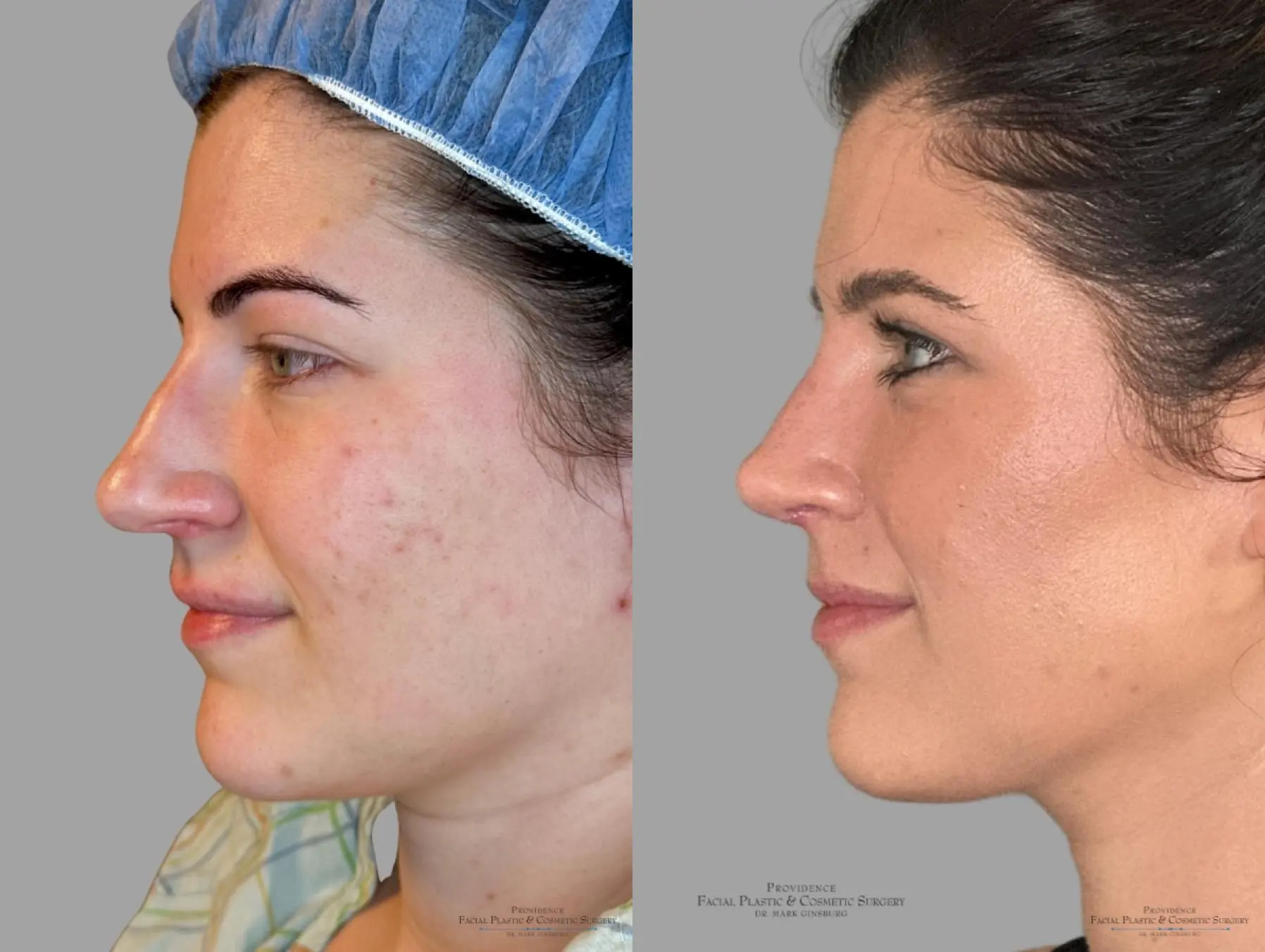 Blepharoplasty: Patient 8 - Before and After 5