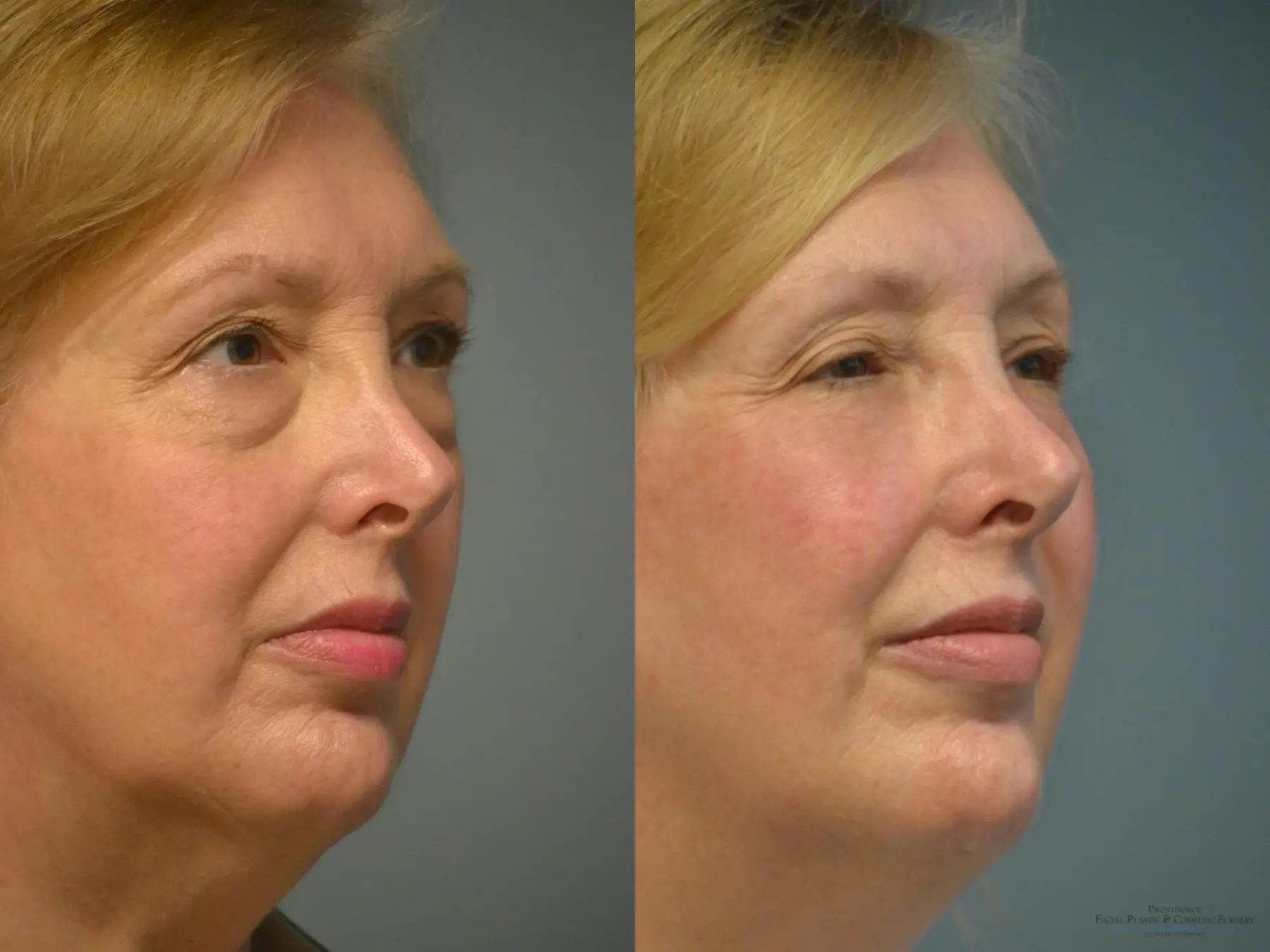 Blepharoplasty: Patient 4 - Before and After 3