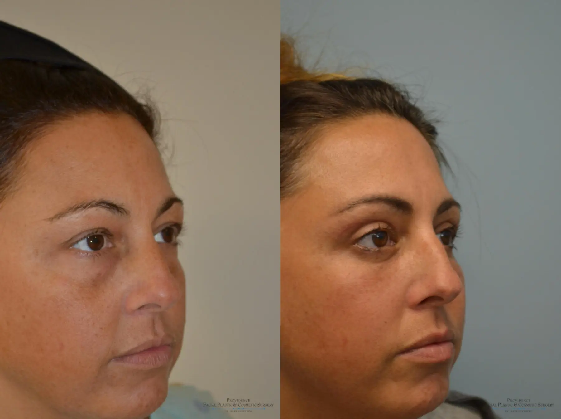 Blepharoplasty: Patient 5 - Before and After 2