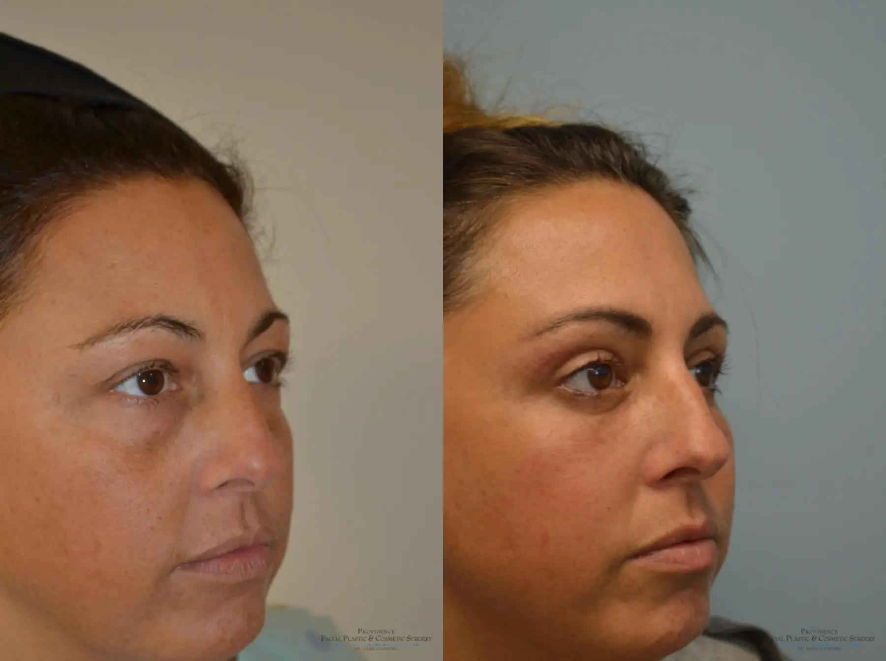 Blepharoplasty: Patient 7 - Before and After 2