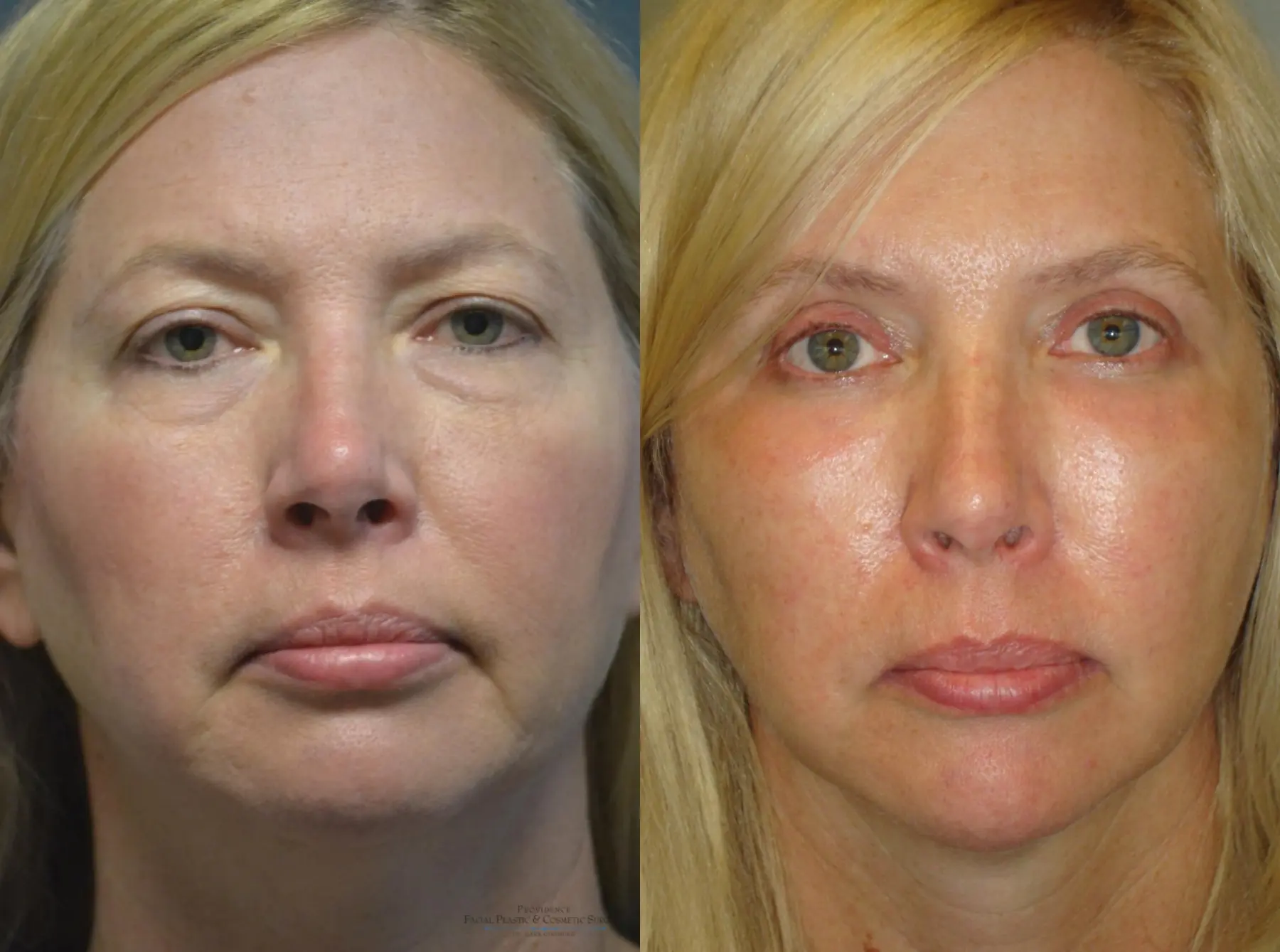 Blepharoplasty: Patient 3 - Before and After  