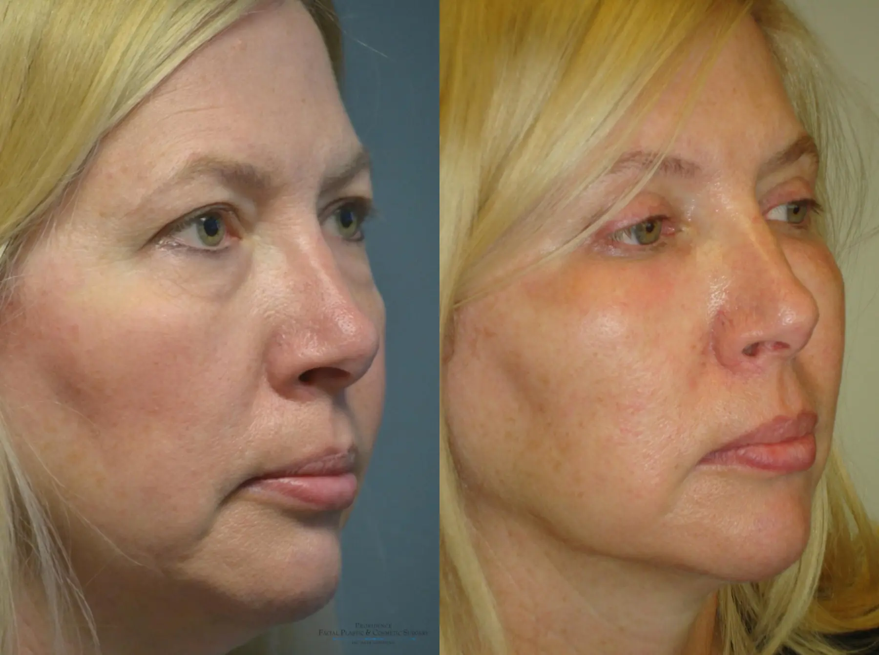 Blepharoplasty: Patient 1 - Before and After 2