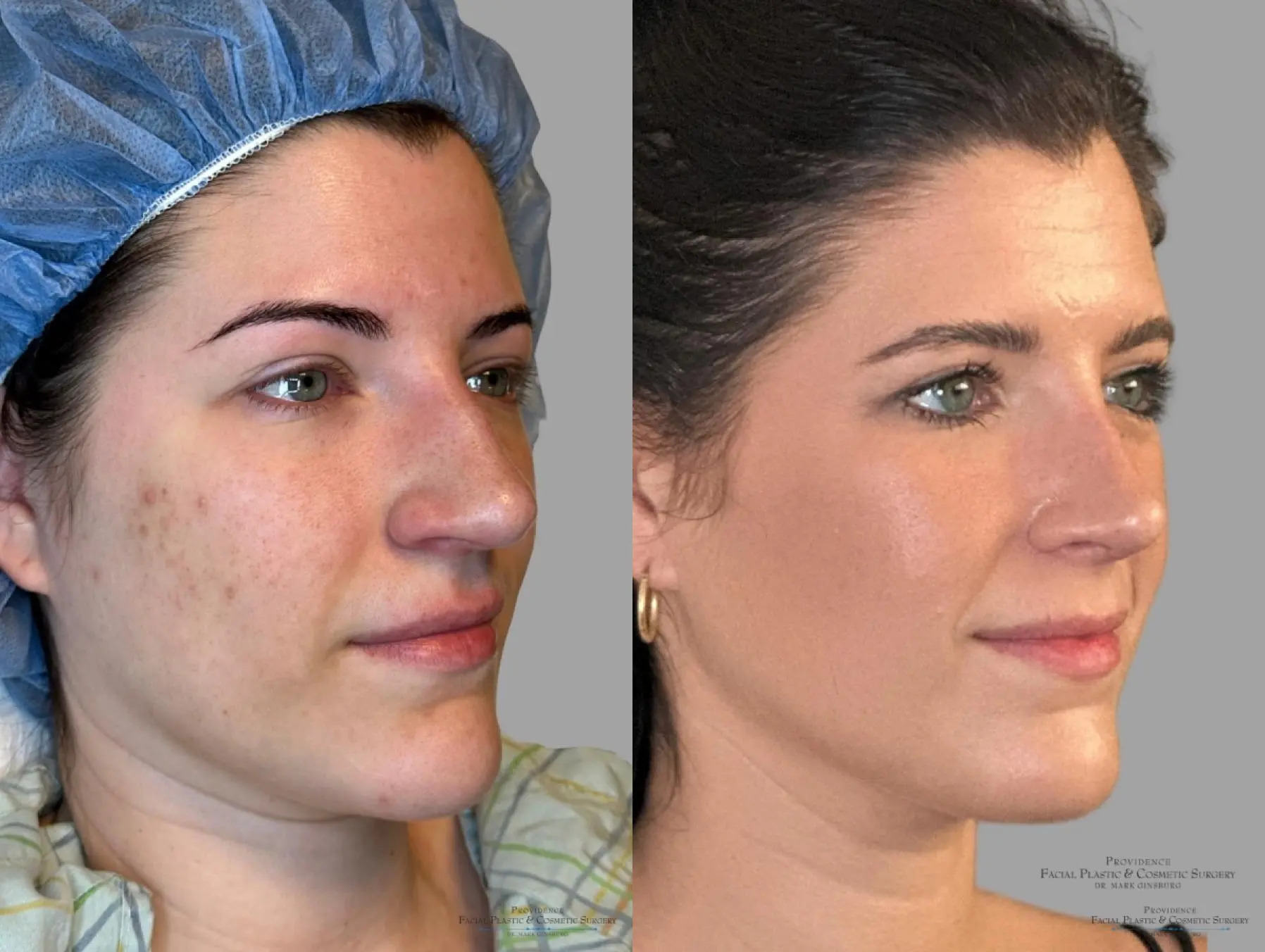Blepharoplasty: Patient 8 - Before and After 2