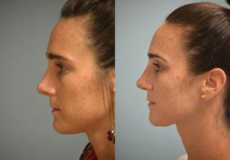 Rhinoplasty: Patient 30 - Before and After 3