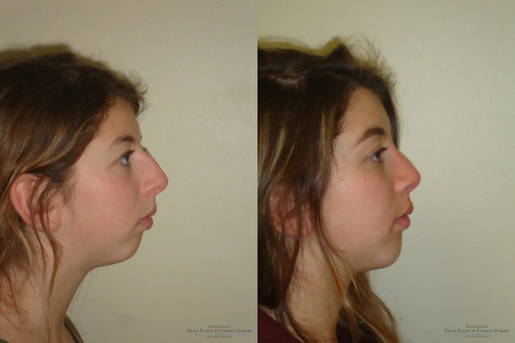 Chin Augmentation: Patient 2 - Before and After 5