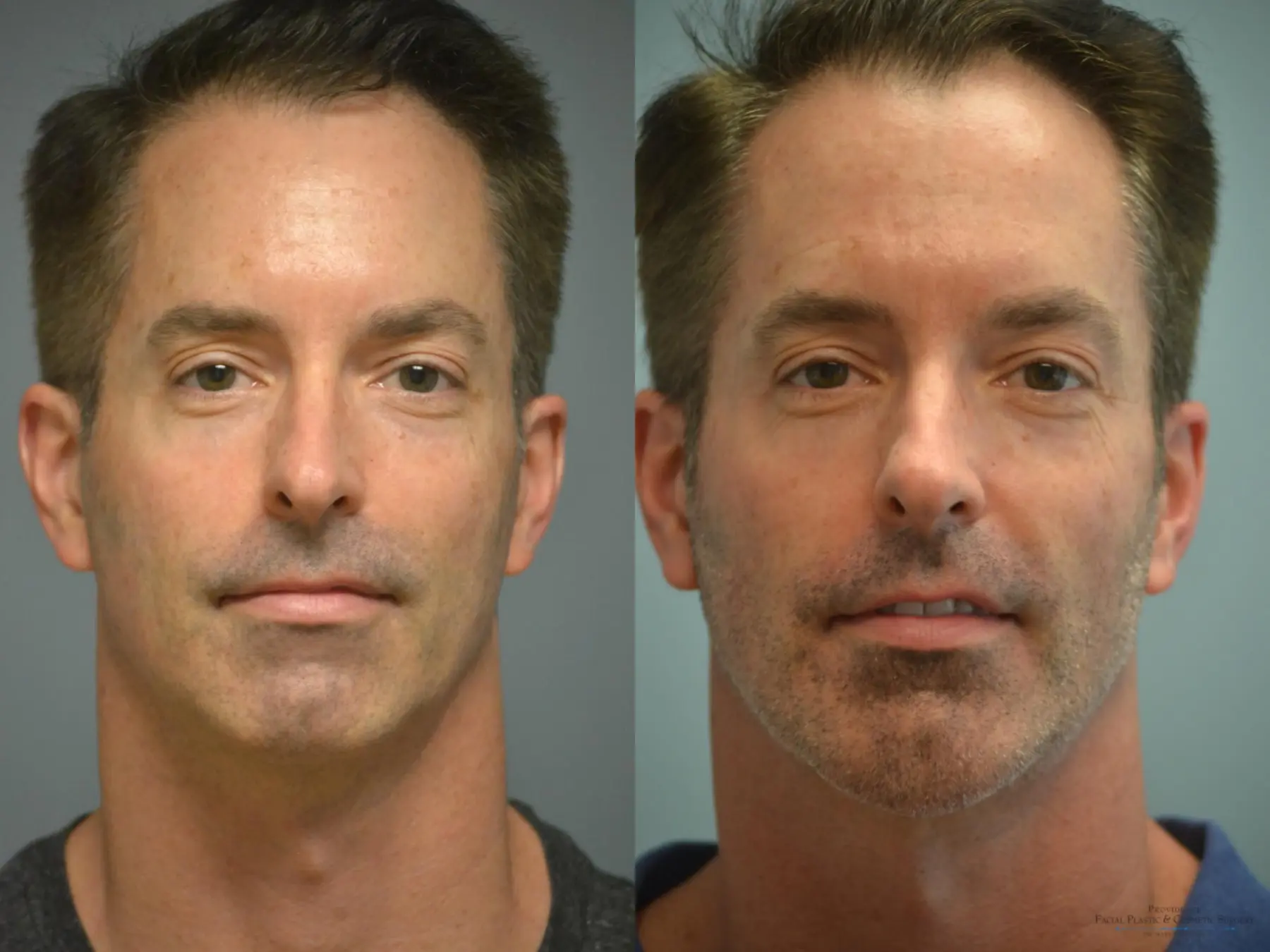 Chin Augmentation: Patient 1 - Before and After 2