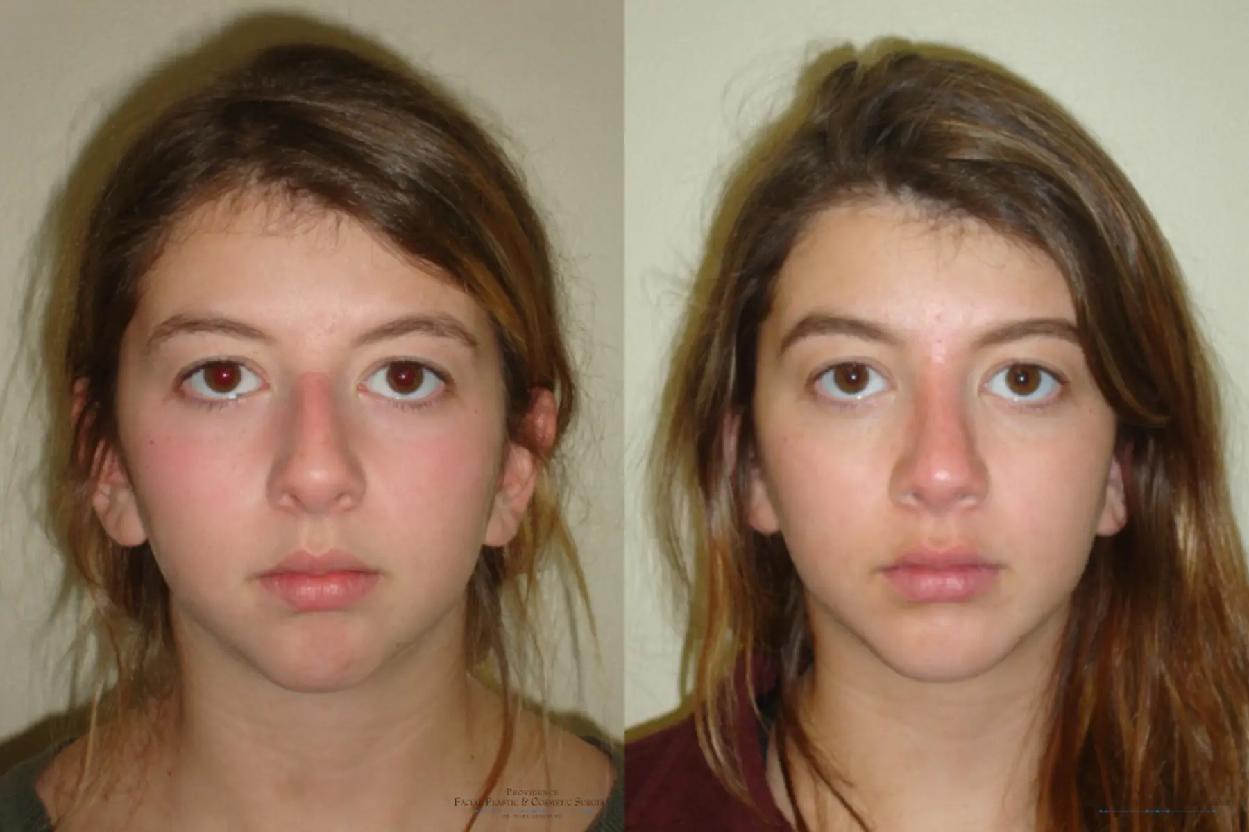 Chin Augmentation: Patient 2 - Before and After 1