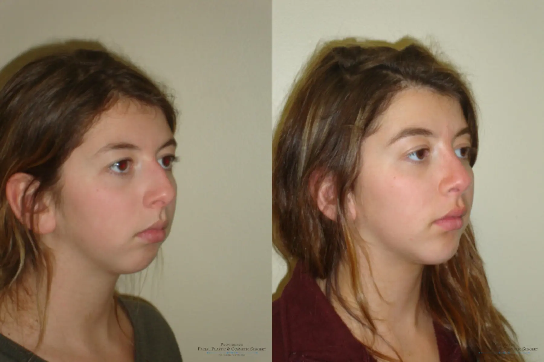 Chin Augmentation: Patient 2 - Before and After 4