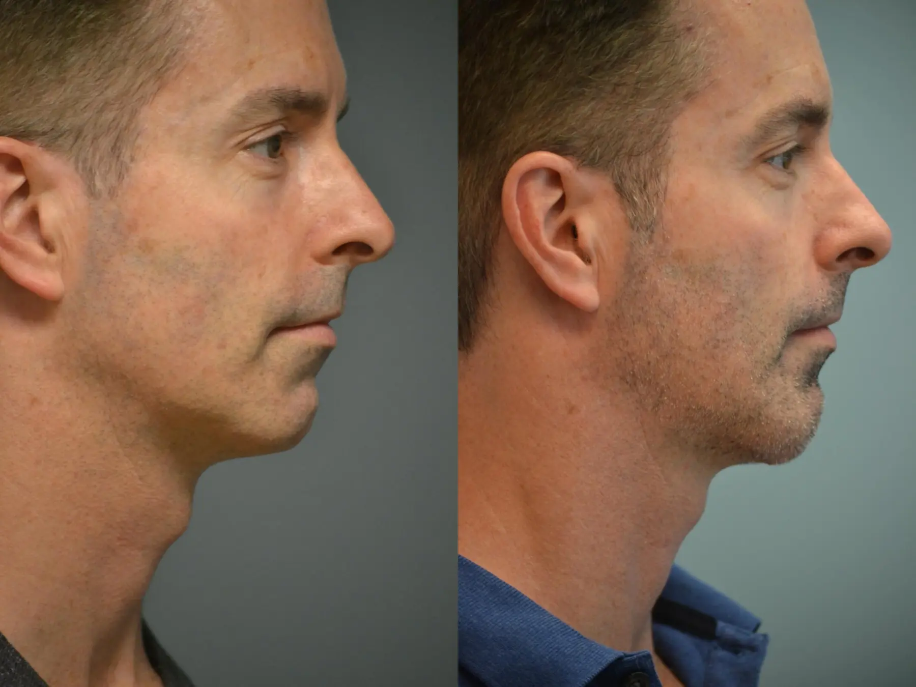Chin Augmentation: Patient 1 - Before and After 3