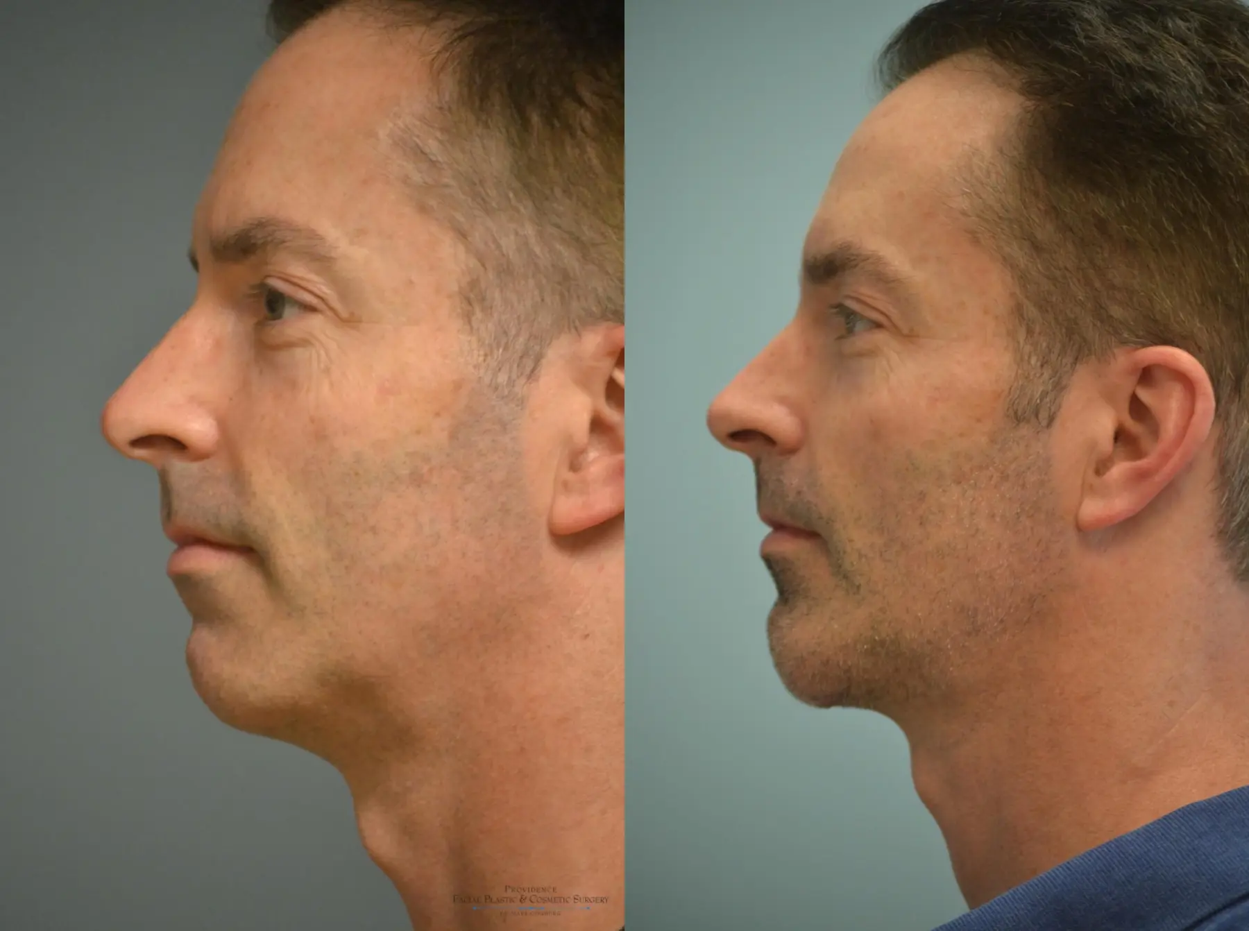 Chin Augmentation: Patient 1 - Before and After 1