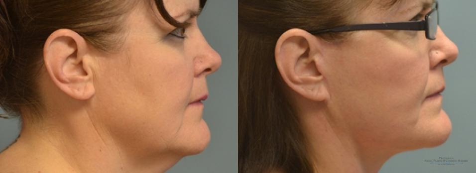 Facelift: Patient 8 - Before and After 3