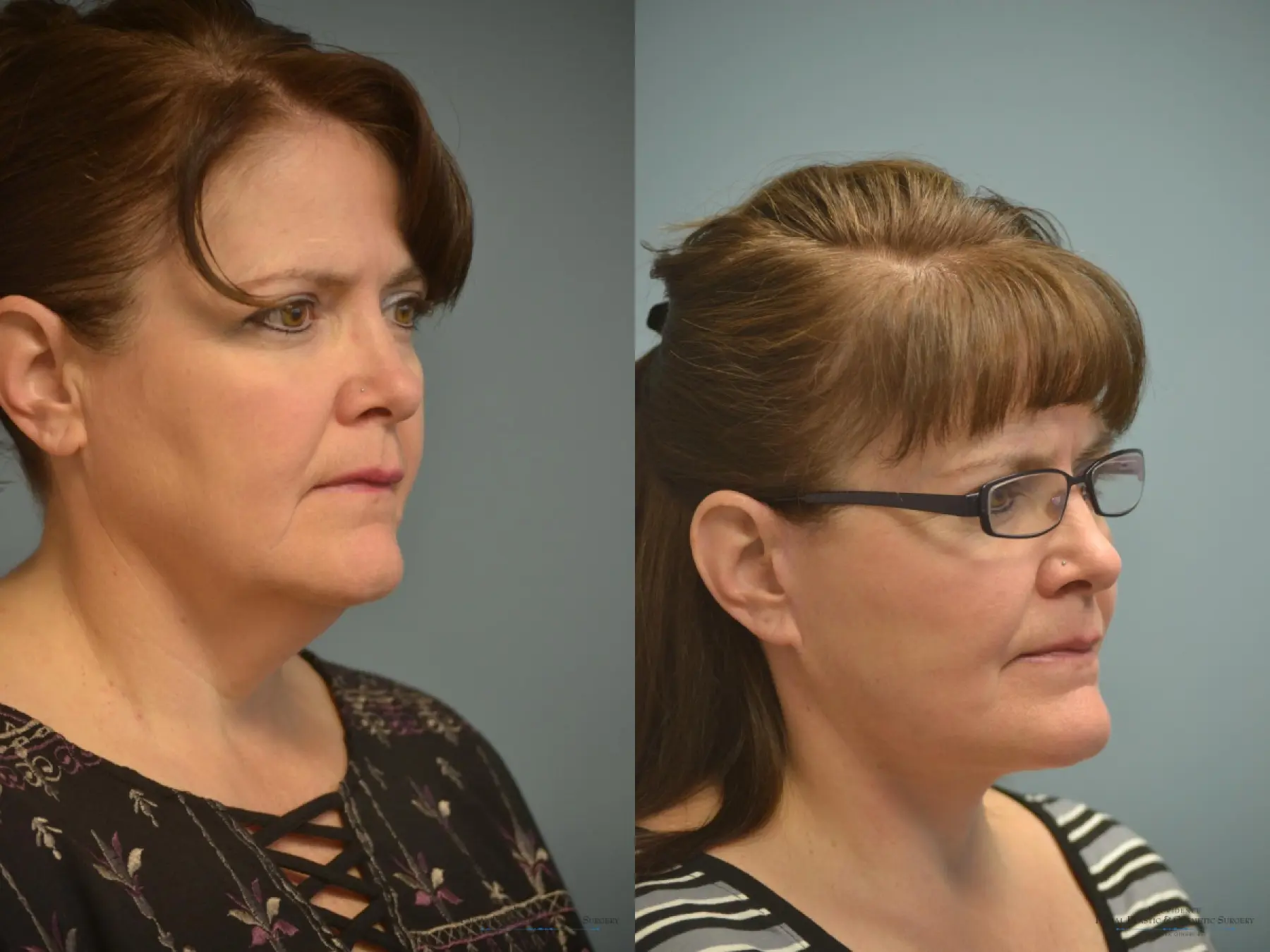 Facelift: Patient 9 - Before and After 3