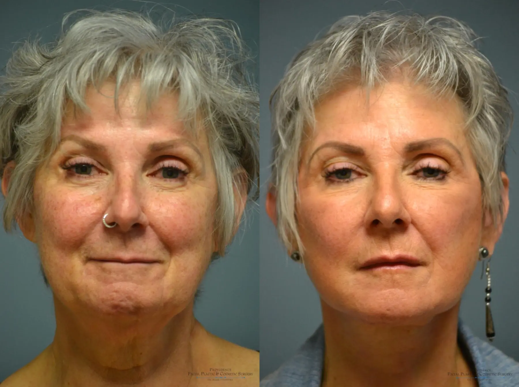Facelift: Patient 14 - Before and After 3