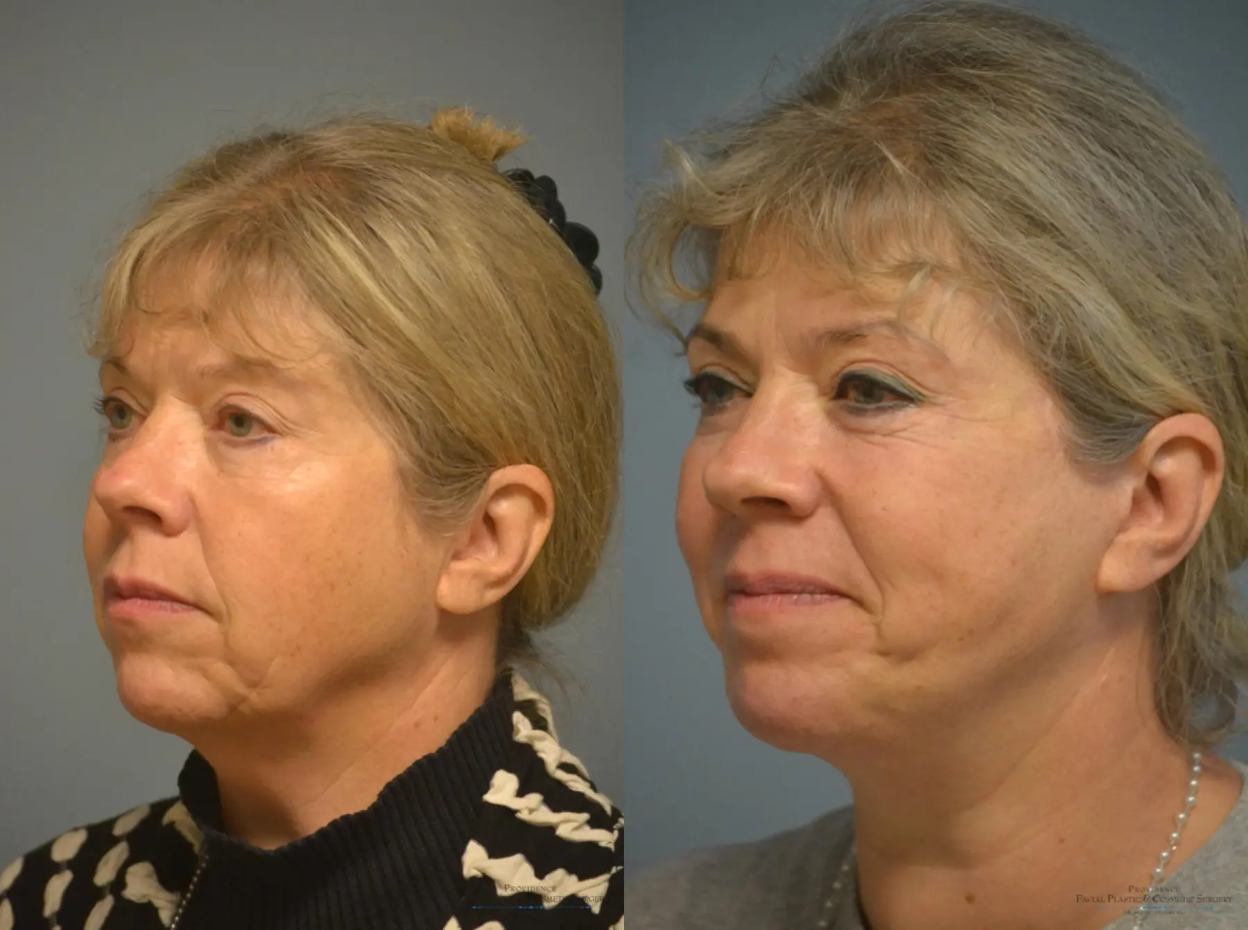 Facelift: Patient 1 - Before and After 3