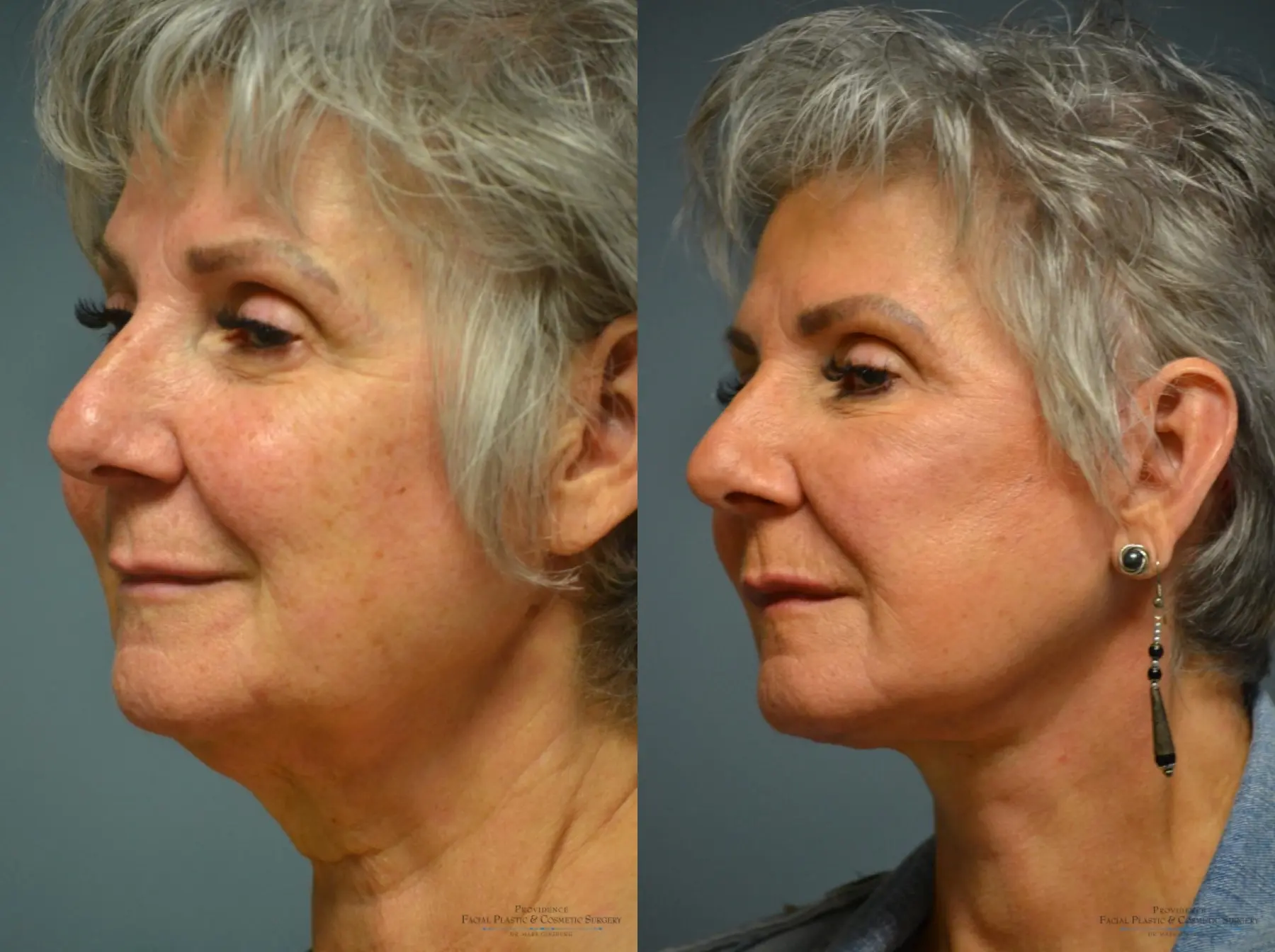 Facelift: Patient 13 - Before and After 2