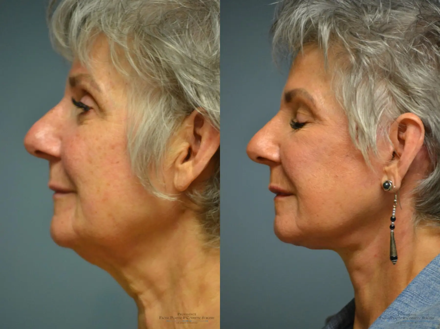 Facelift: Patient 13 - Before and After 1