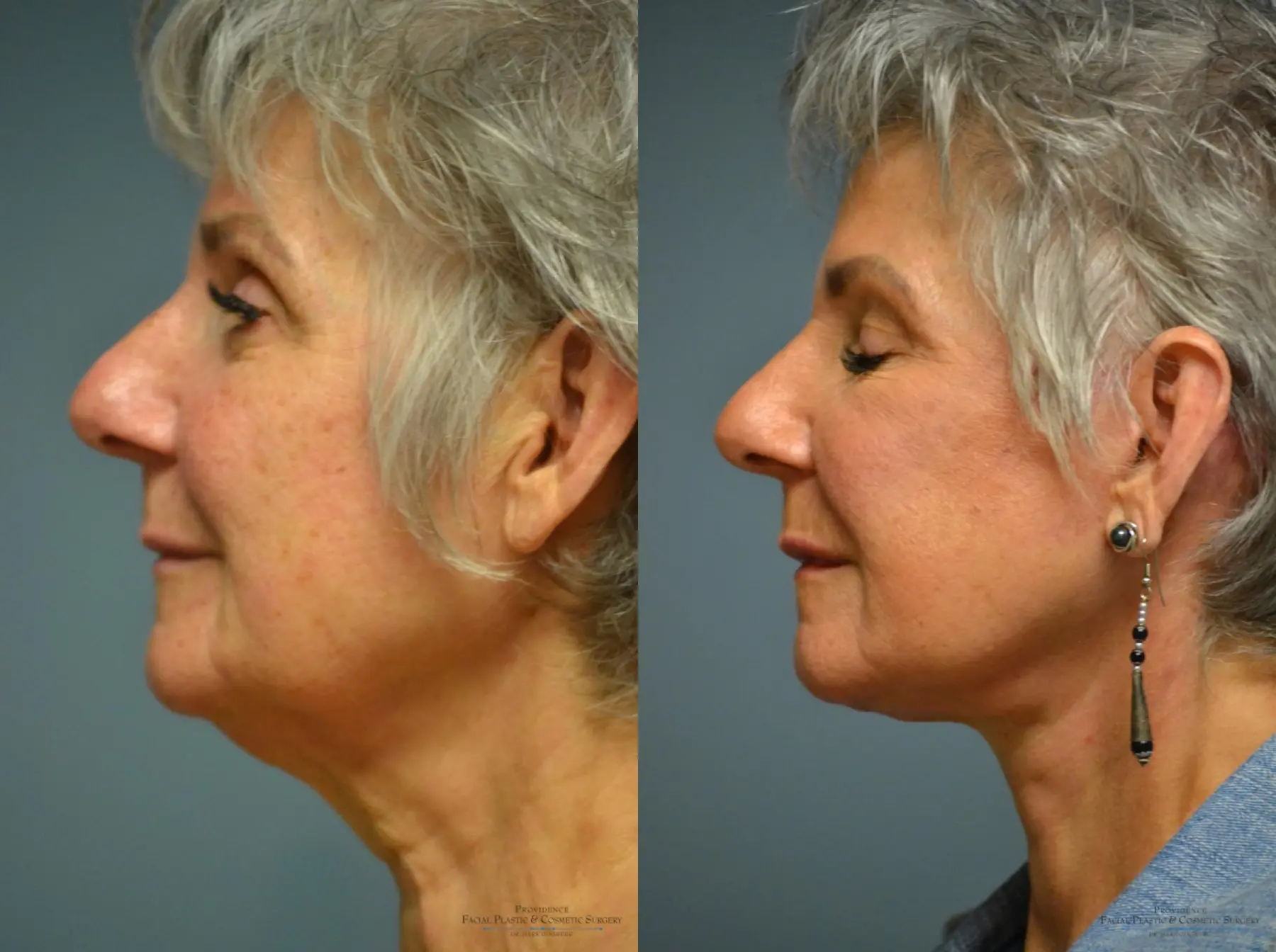 Facelift: Patient 14 - Before and After 1