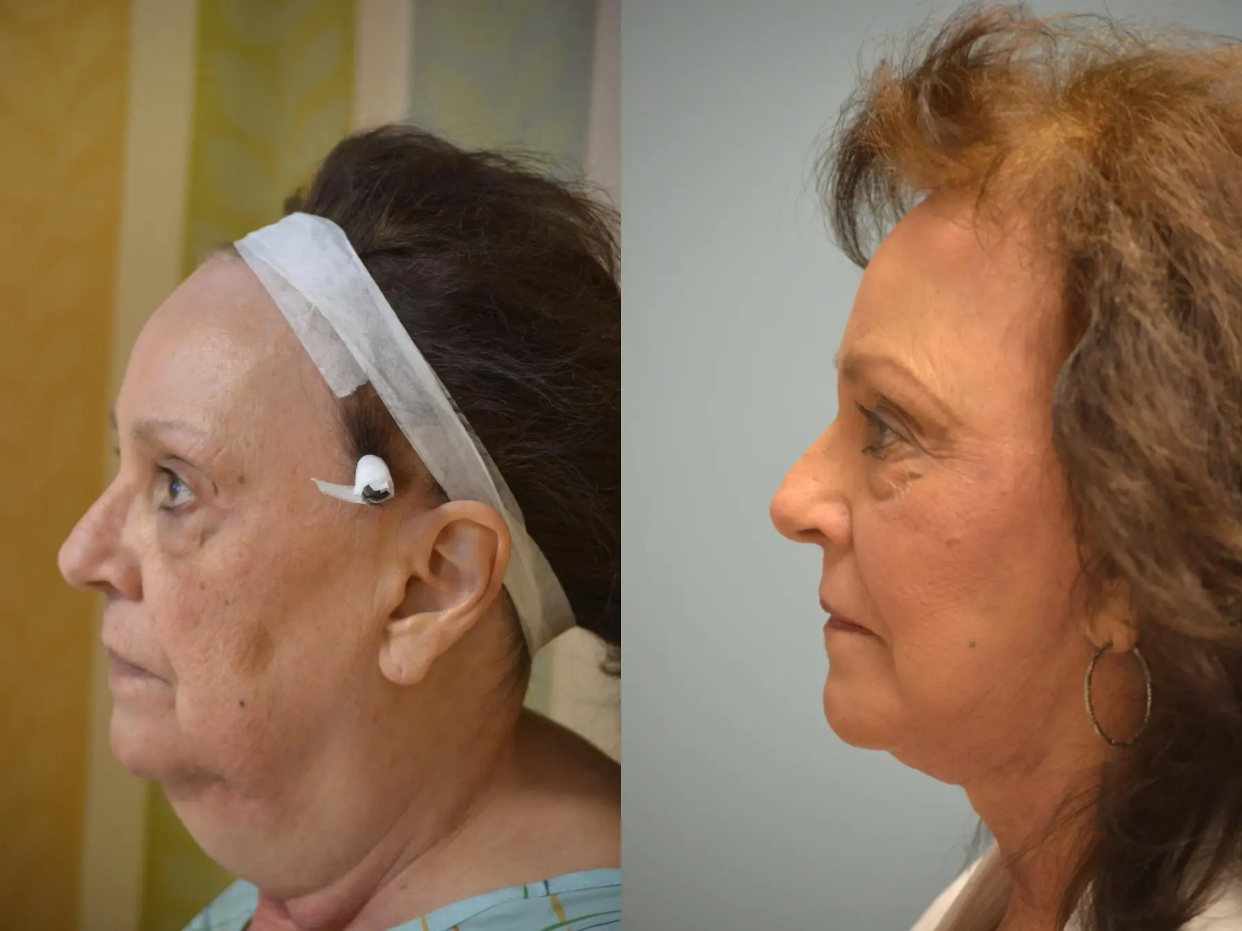 Facelift: Patient 12 - Before and After 2