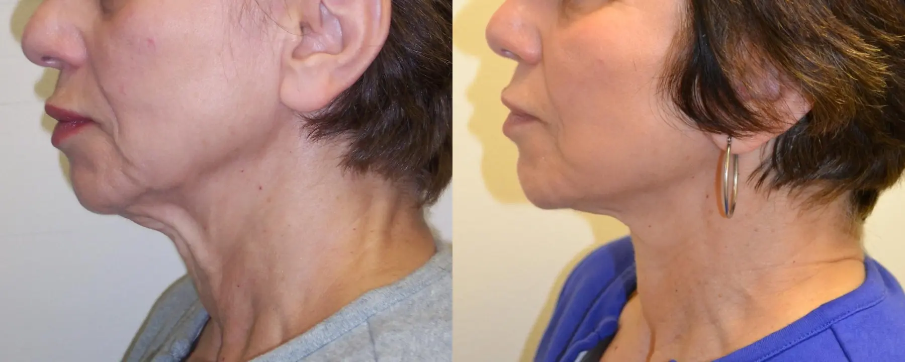 Facelift: Patient 10 - Before and After 3