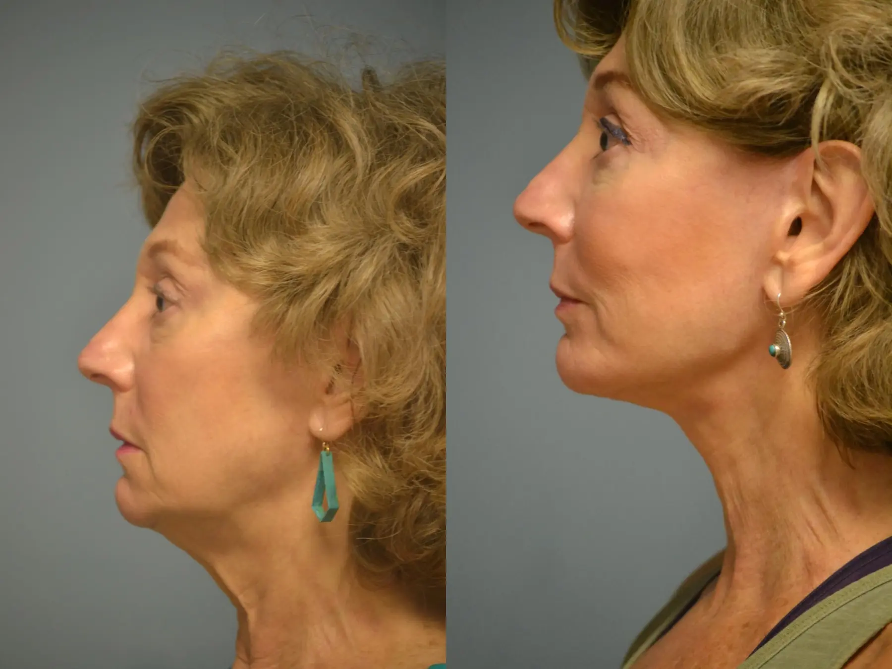 Facelift: Patient 12 - Before and After 3