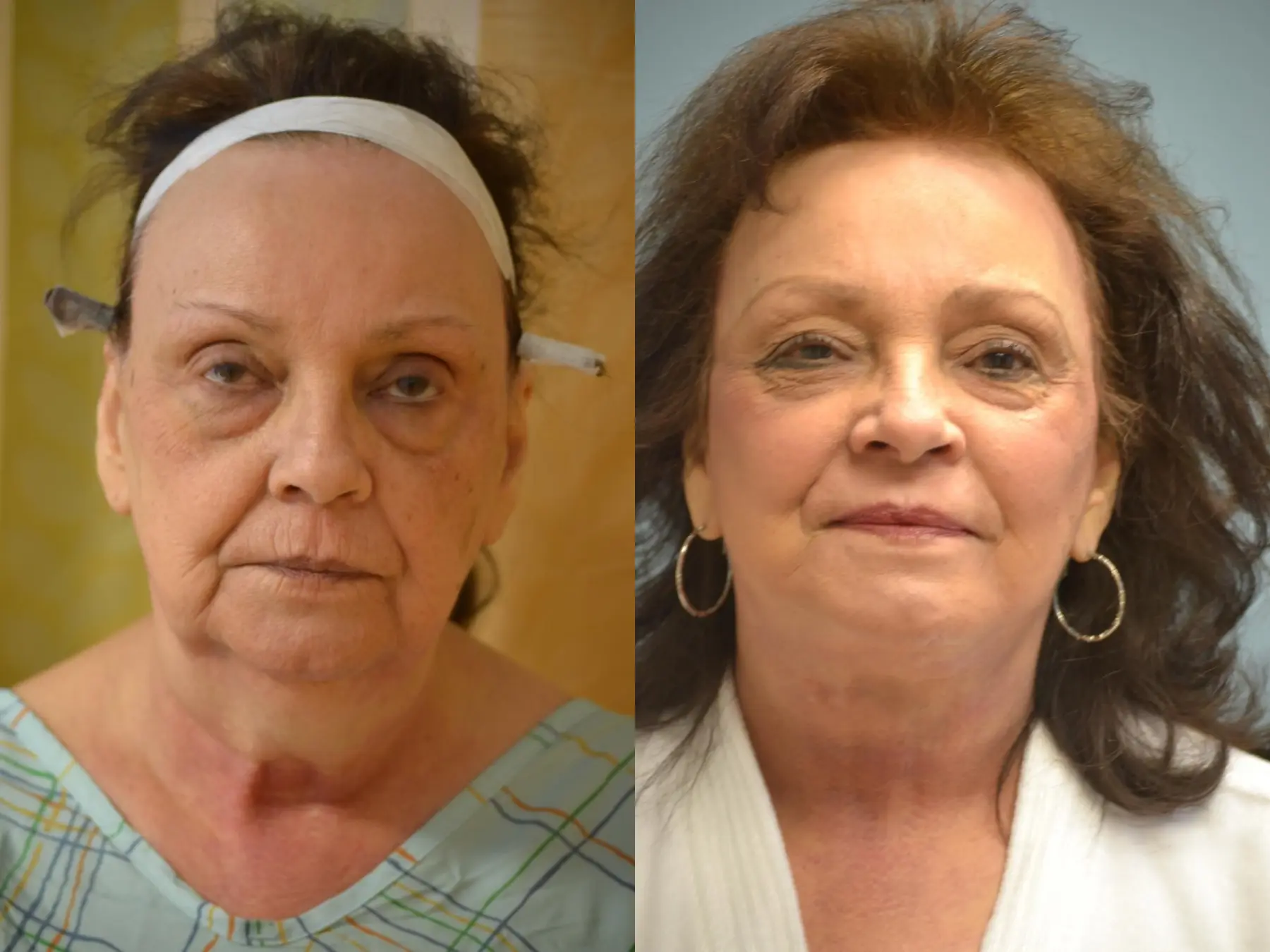 Facelift: Patient 12 - Before and After 1